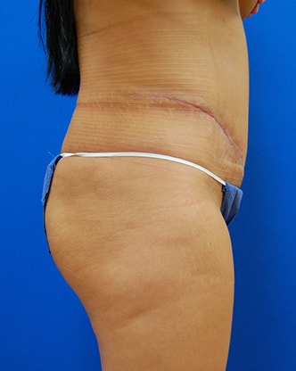 A result from Brzowski Plastic Surgery