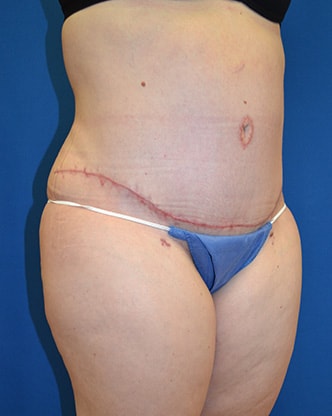 A result from Brzowski Plastic Surgery