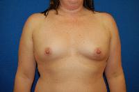 Breast Augmentation before photo