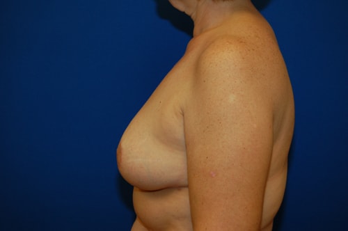 A result from Brzowski Plastic Surgery