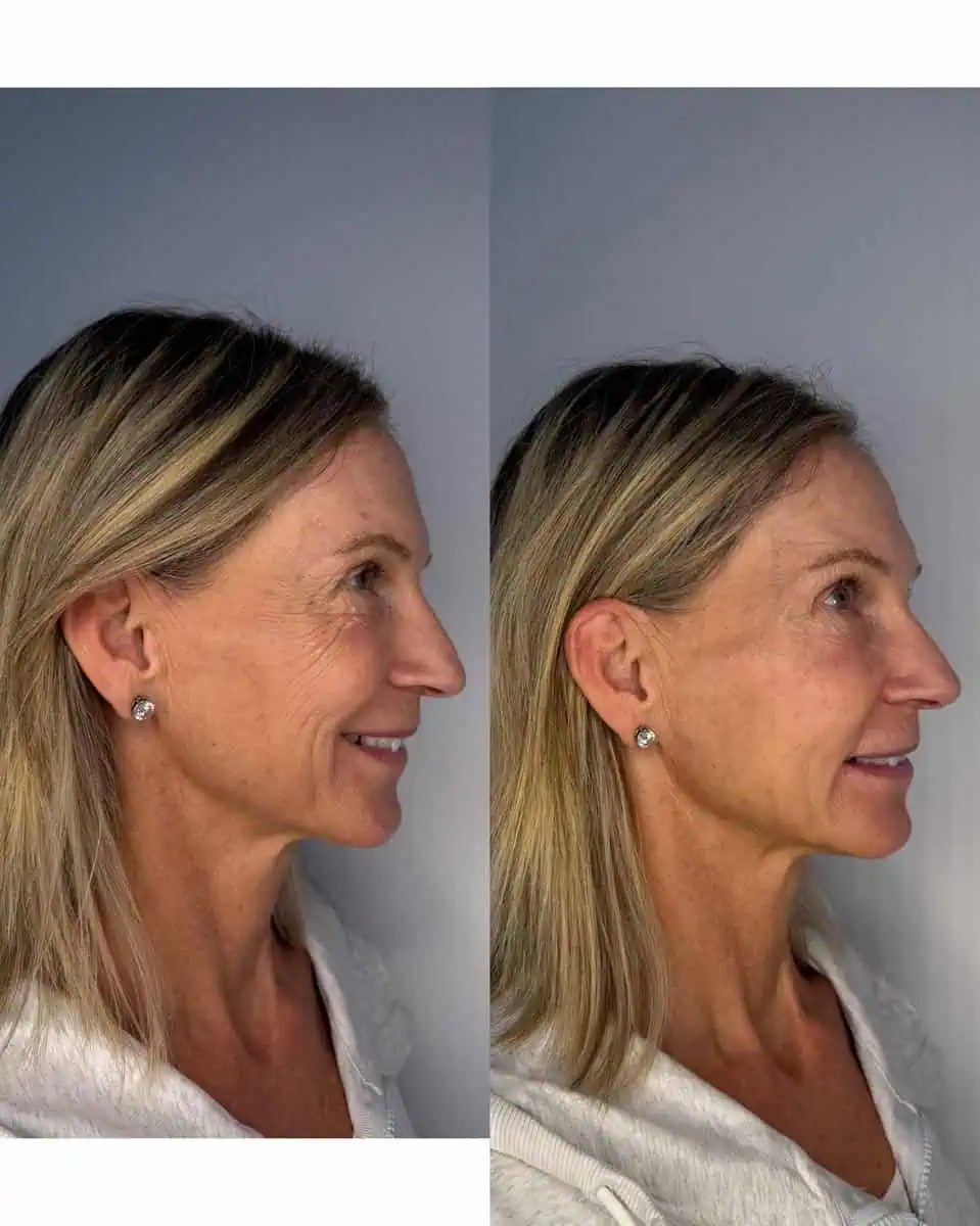 A result from KDR MedSpa + Wellness