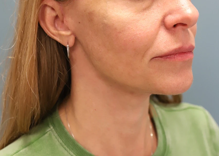 A result from The Lucas Center Cosmetic & Plastic Surgery