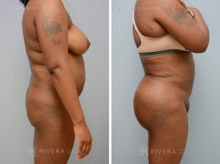 A result from Rivera Plastic Surgery