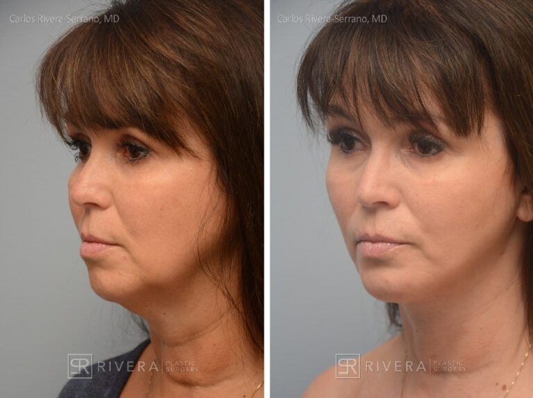A result from Rivera Plastic Surgery
