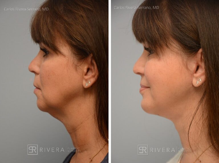 A result from Rivera Plastic Surgery