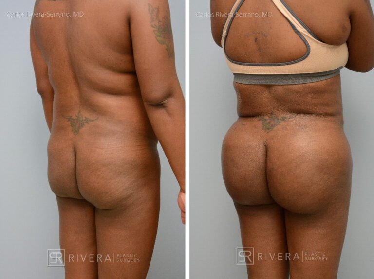 A result from Rivera Plastic Surgery