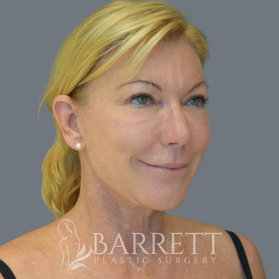 A result from Barrett Plastic Surgery