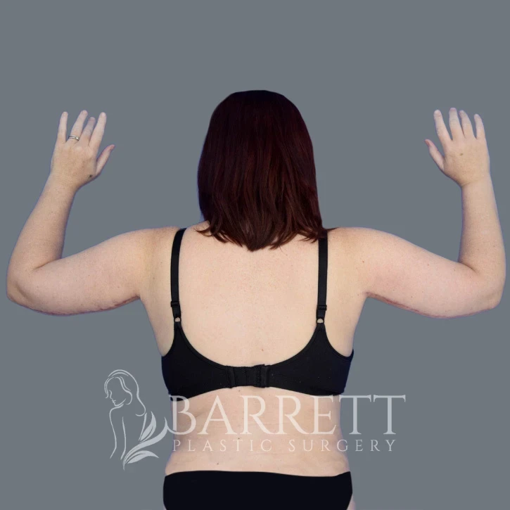 A result from Barrett Plastic Surgery