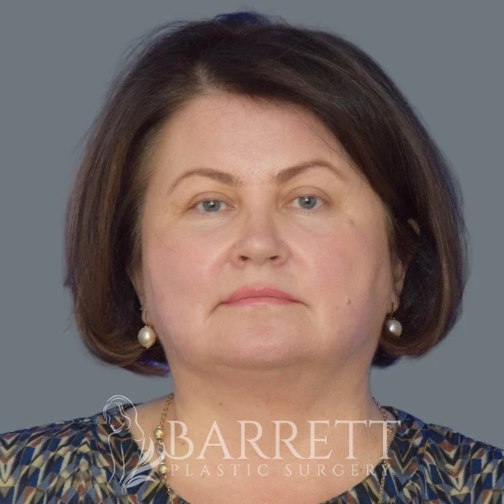 A result from Barrett Plastic Surgery