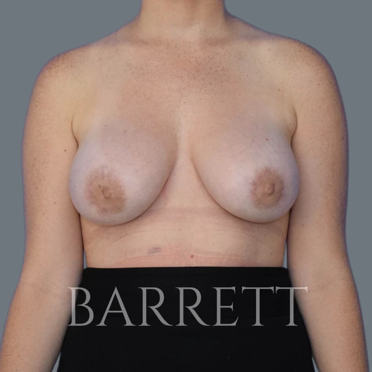 A result from Barrett Plastic Surgery
