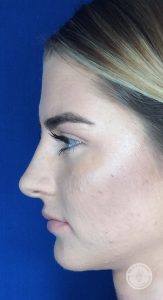 A result from Dr. J. J. Wendel Plastic Surgery