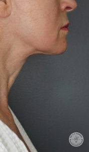 A result from Dr. J. J. Wendel Plastic Surgery