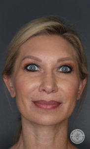 A result from Dr. J. J. Wendel Plastic Surgery