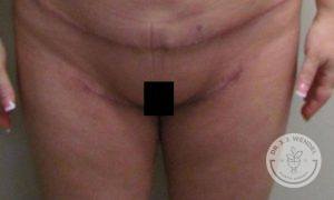 A result from Dr. J. J. Wendel Plastic Surgery