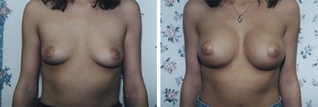 A result from Bohley Plastic Surgery Center