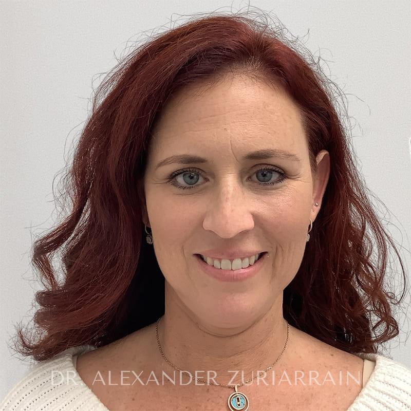 Blepharoplasty result at Zuri Plastic Surgery - Dr. Zuriarrain