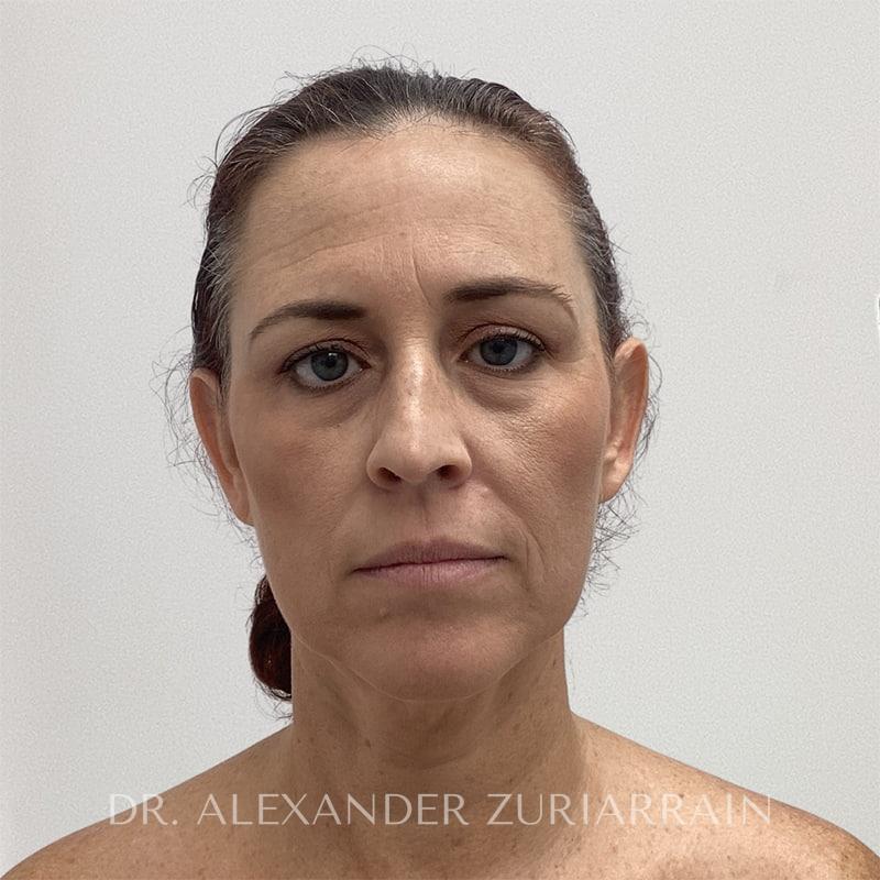Blepharoplasty before photo