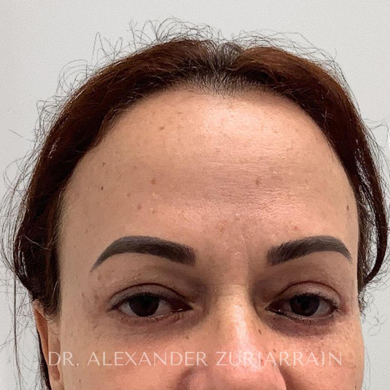 Blepharoplasty result at Zuri Plastic Surgery - Dr. Zuriarrain