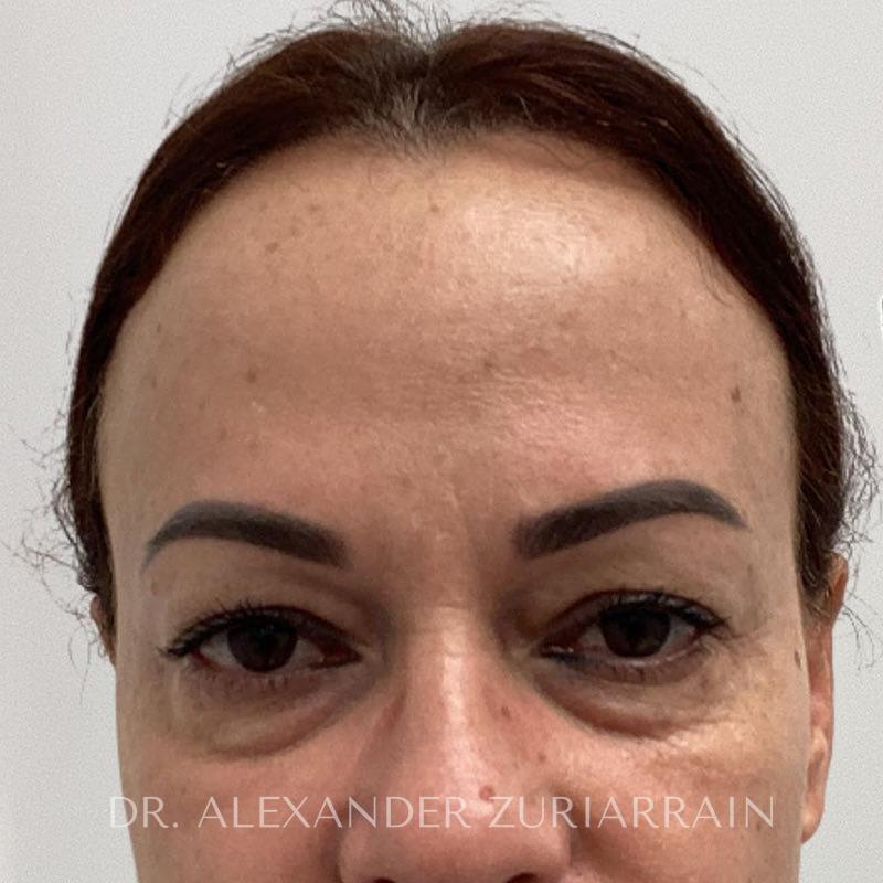 Blepharoplasty before photo
