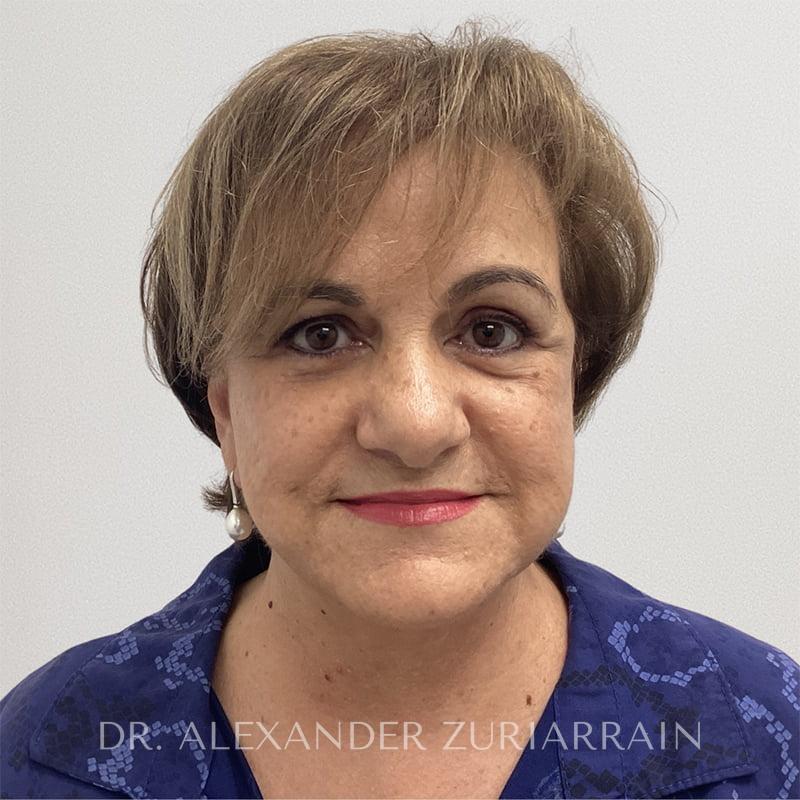 Facelift result at Zuri Plastic Surgery - Dr. Zuriarrain