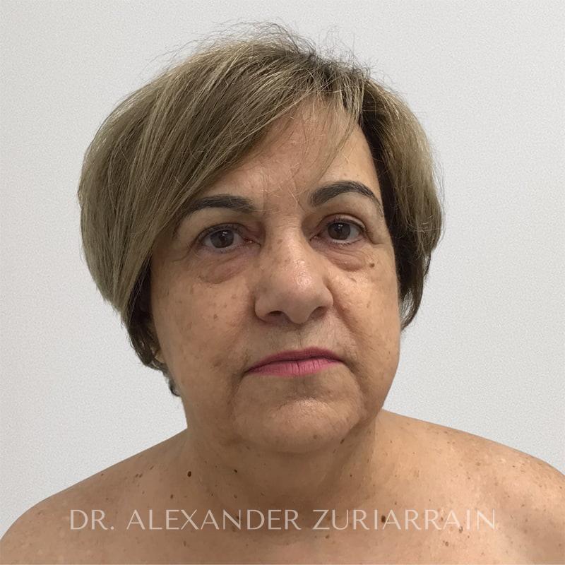 Facelift before photo