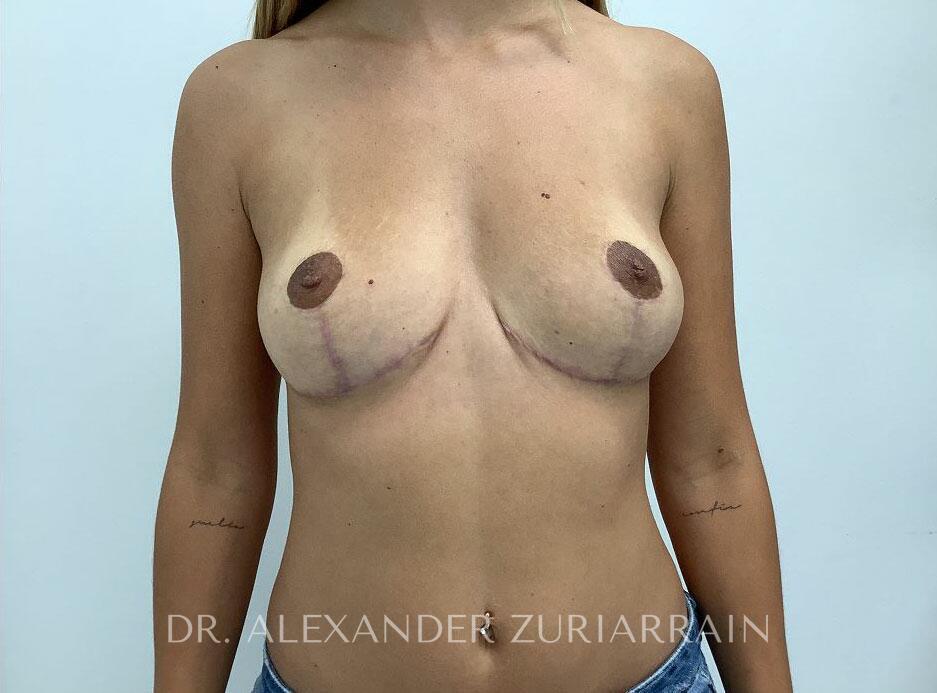 Implant Revision result at Zuri Plastic Surgery - Dr. Zuriarrain