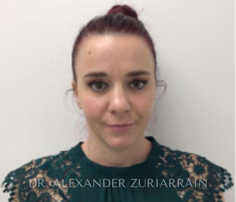 Blepharoplasty result at Zuri Plastic Surgery - Dr. Zuriarrain