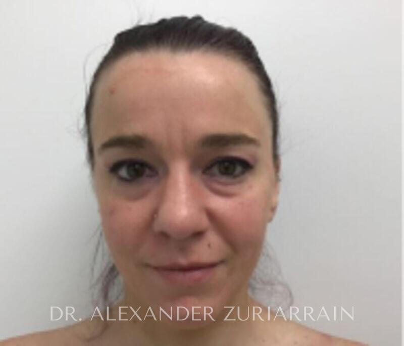 Blepharoplasty before photo