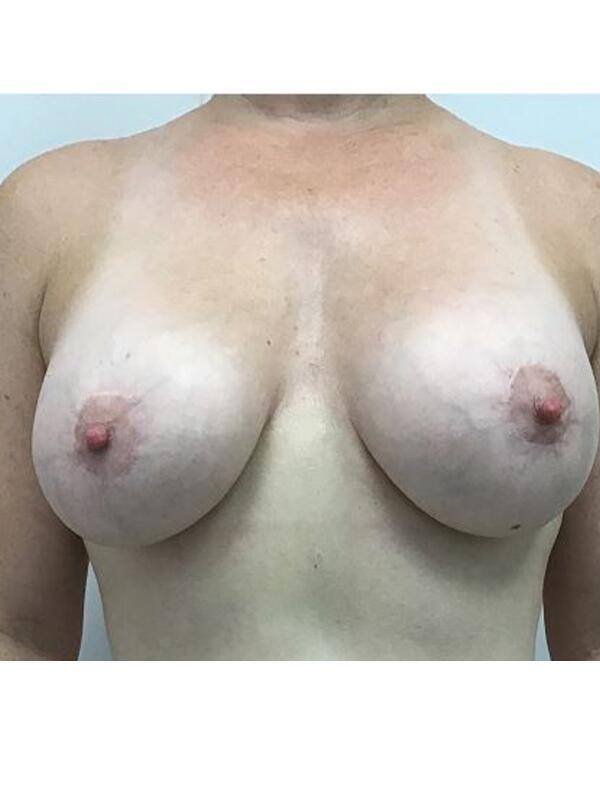 Breast Lift result at Zuri Plastic Surgery - Dr. Zuriarrain