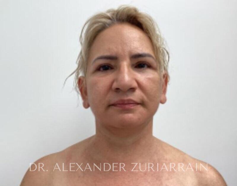 Facelift result at Zuri Plastic Surgery - Dr. Zuriarrain