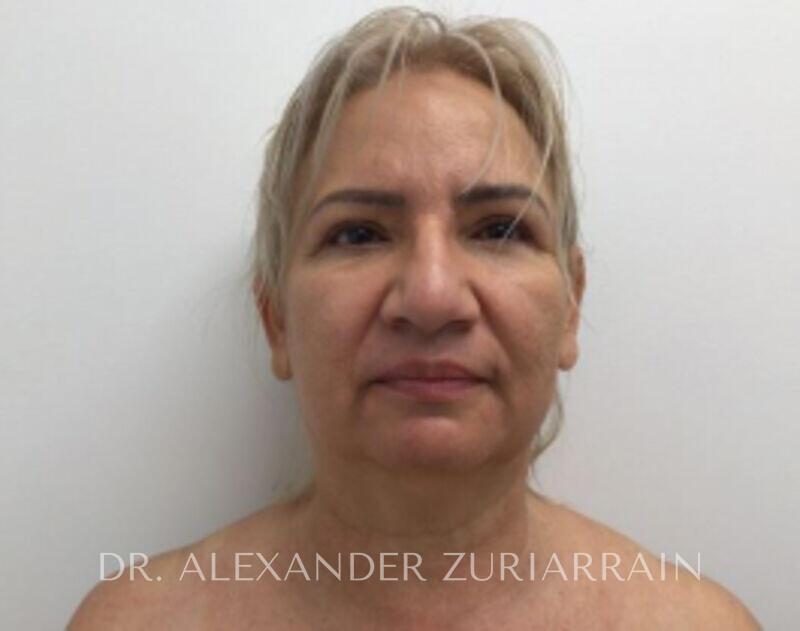 Facelift before photo