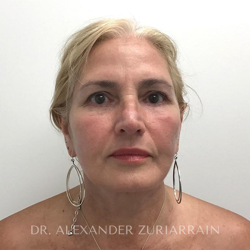 Facelift result at Zuri Plastic Surgery - Dr. Zuriarrain