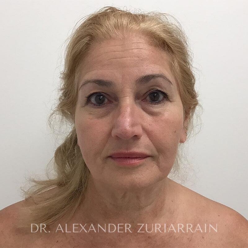 Facelift before photo