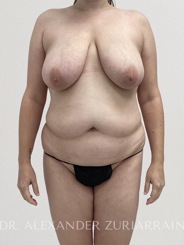 Tummy Tuck before photo