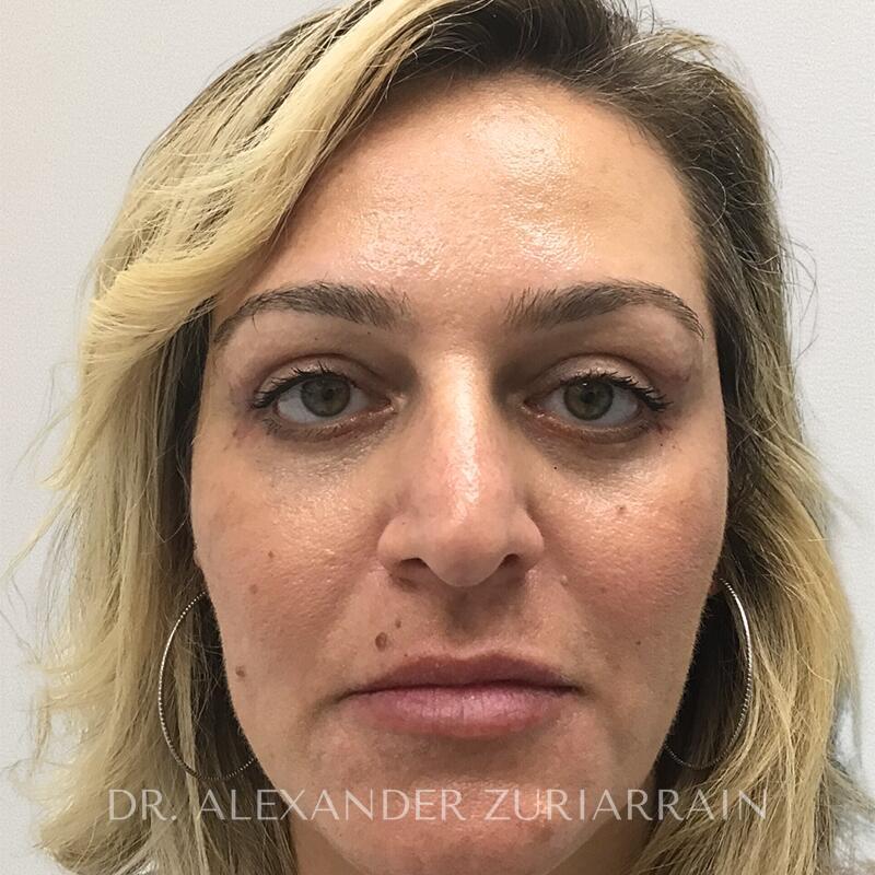 Blepharoplasty result at Zuri Plastic Surgery - Dr. Zuriarrain