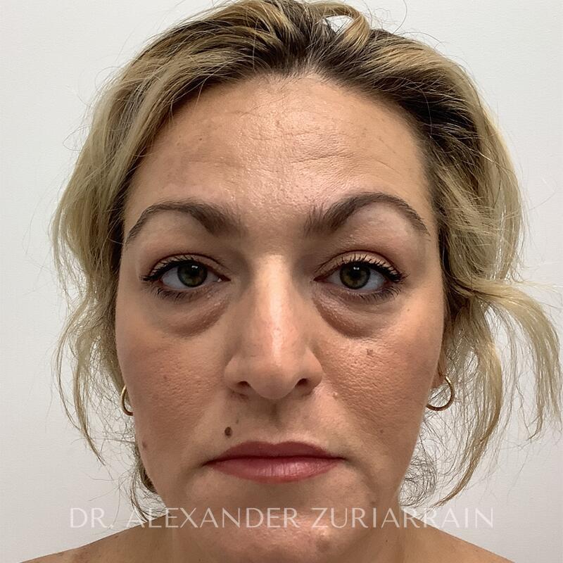 Blepharoplasty before photo
