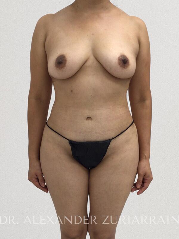 Tummy Tuck result at Zuri Plastic Surgery - Dr. Zuriarrain
