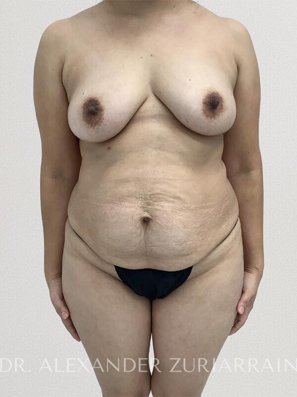 Tummy Tuck before photo