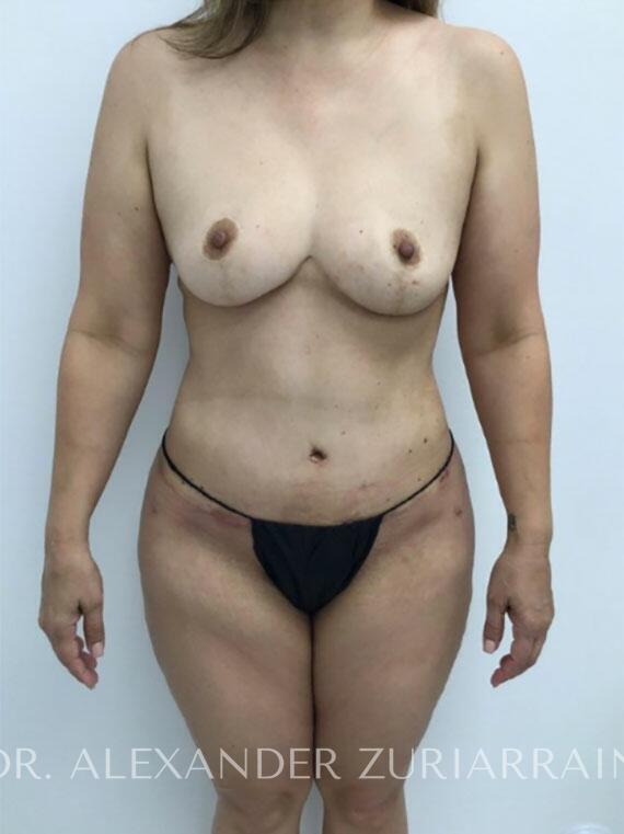 Tummy Tuck result at Zuri Plastic Surgery - Dr. Zuriarrain