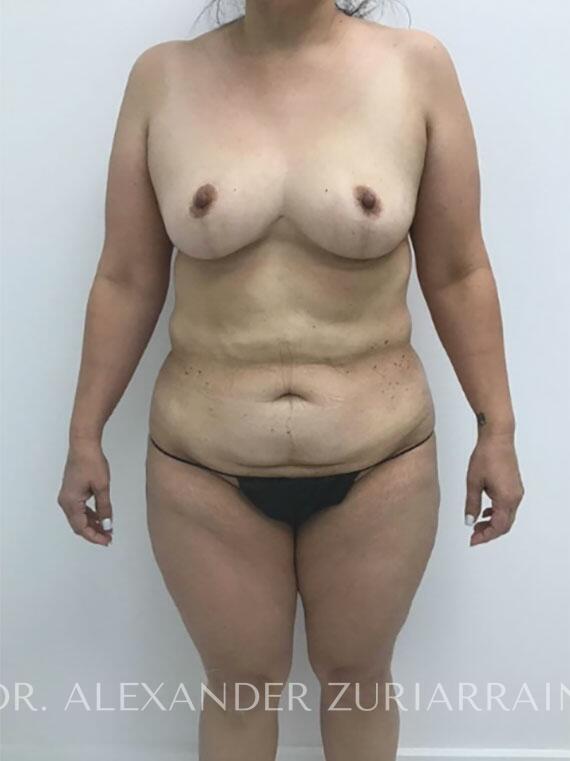 Tummy Tuck before photo
