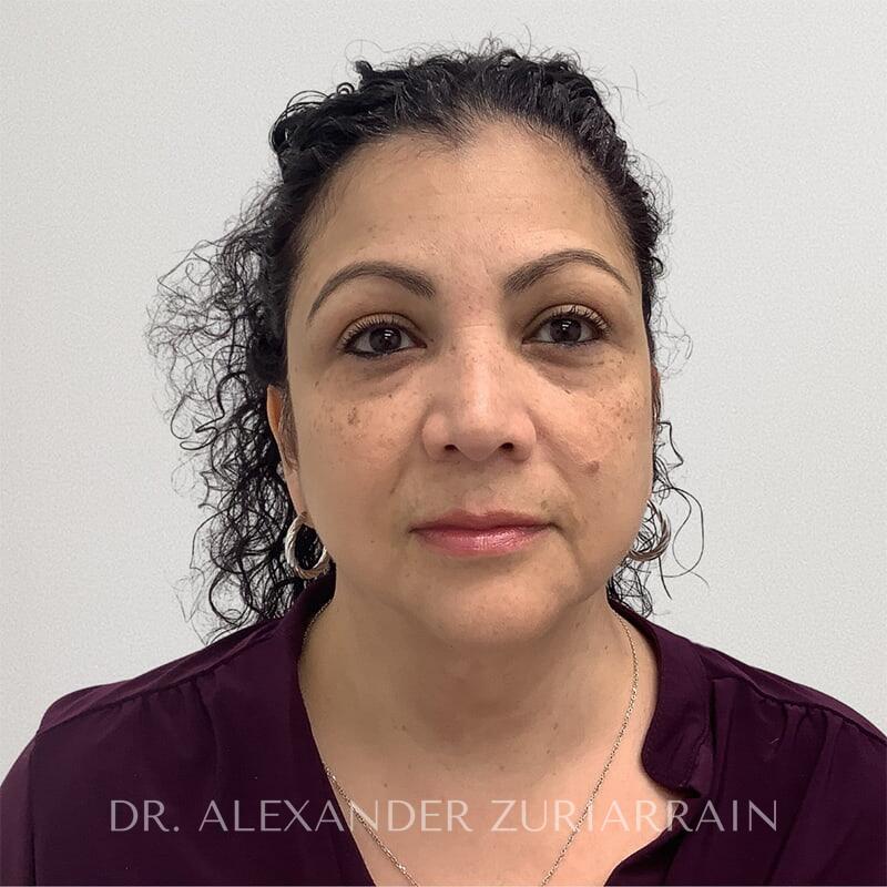 Facelift result at Zuri Plastic Surgery - Dr. Zuriarrain