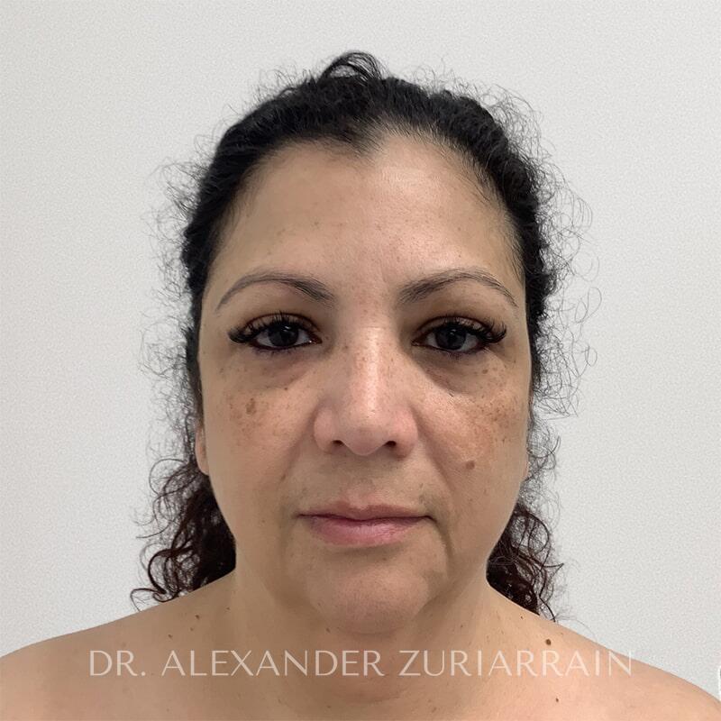 Facelift before photo
