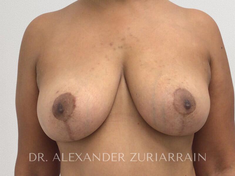 Breast Lift result at Zuri Plastic Surgery - Dr. Zuriarrain