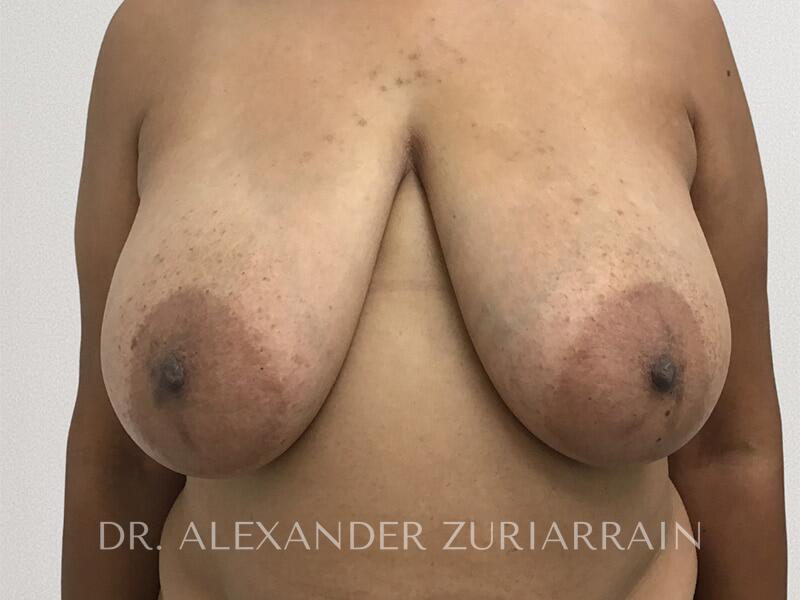 Breast Lift before photo