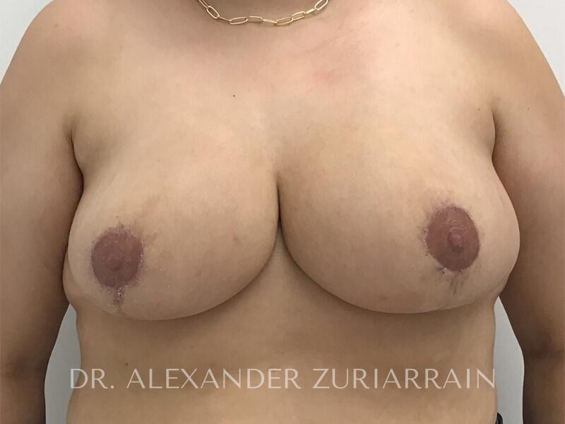 Breast Reduction result at Zuri Plastic Surgery - Dr. Zuriarrain