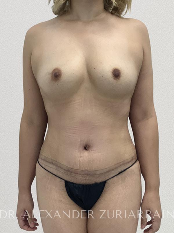 Tummy Tuck result at Zuri Plastic Surgery - Dr. Zuriarrain