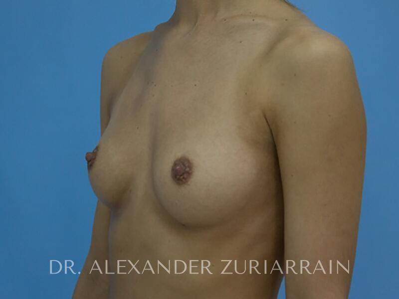 Breast Augmentation before photo