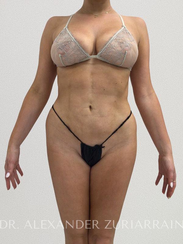 Liposuction result at Zuri Plastic Surgery - Dr. Zuriarrain
