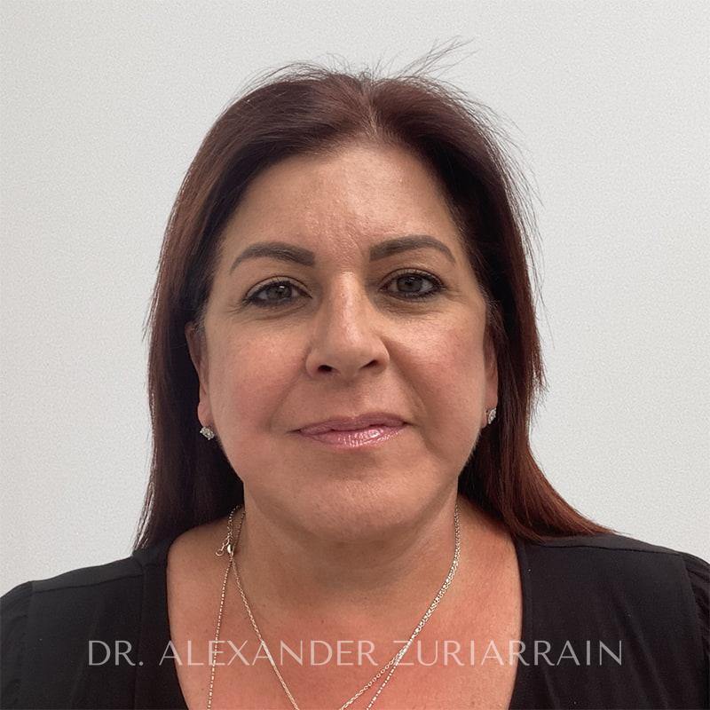 Facelift result at Zuri Plastic Surgery - Dr. Zuriarrain