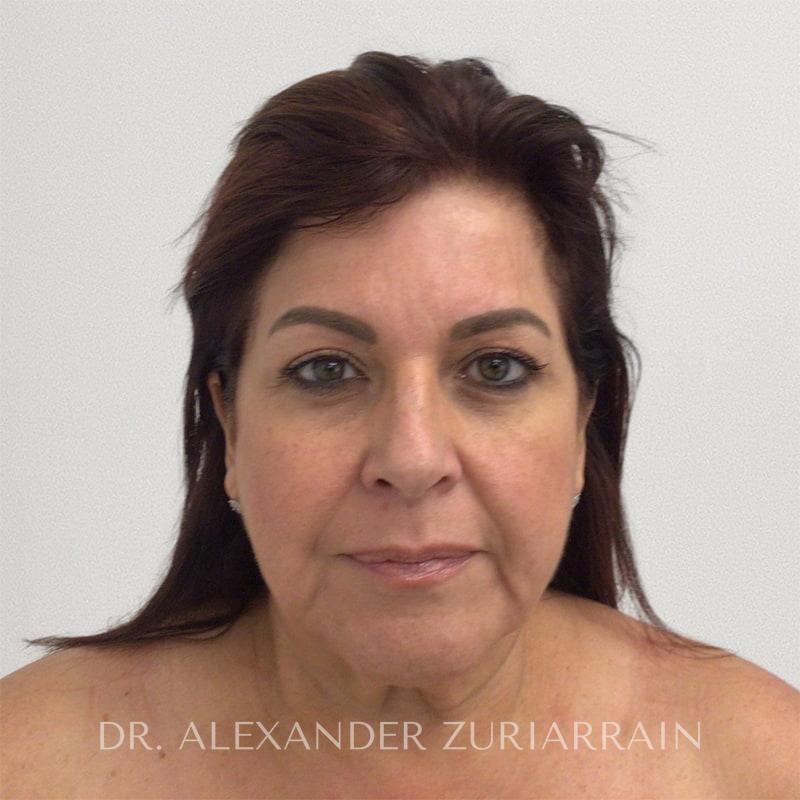 Facelift before photo